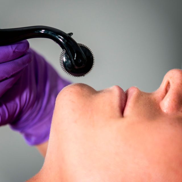 Microneedling